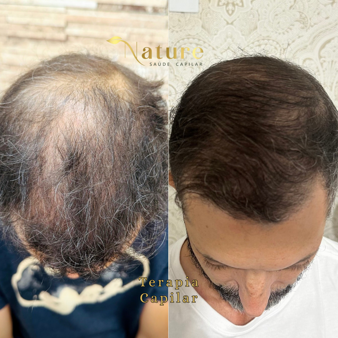 Alopecia androgenética masculino