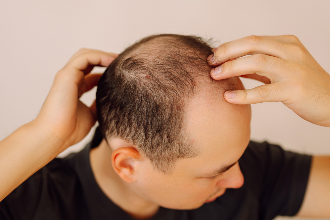 Nature Saúde Capilar é especializada na Terapia Capilar Integrativa, oferecendo protocolos profundos e eficazes, tanto para o público feminino quanto para o masculino. Nossa premissa é um tratamento customizado que atua na raiz dos problemas, promovendo a saúde de forma integral.